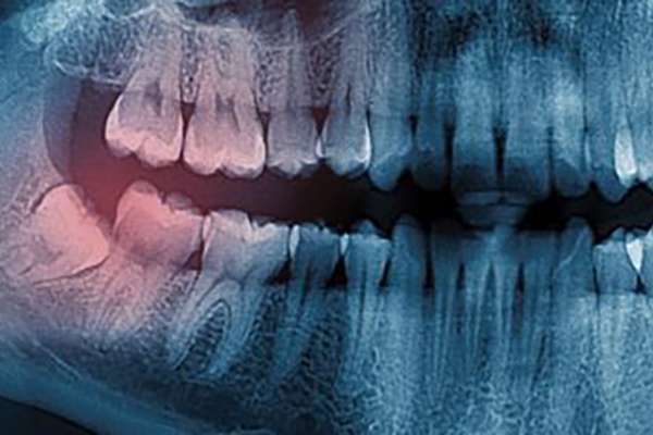 Wisdom Teeth